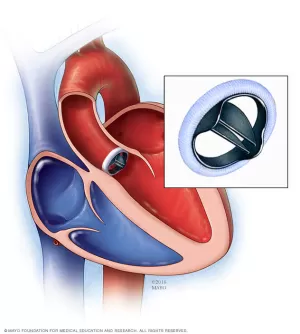 Heart Valve Replacement above of the Page