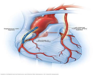 Heart Bypass Surgery above of the Page