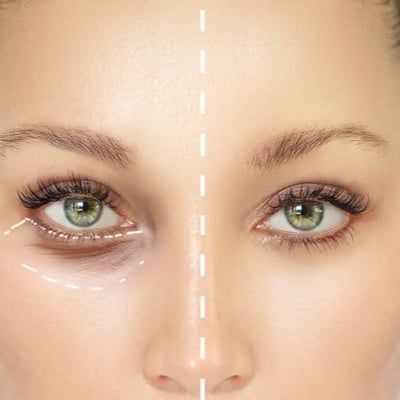 Blepharoplasty above of the Page