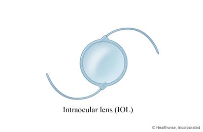 Intraocular lens above of the Page